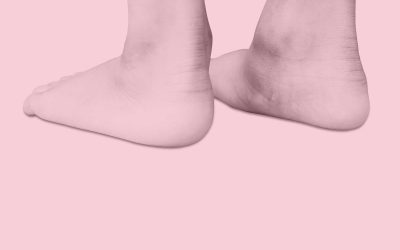 Pediatric Flat Feet