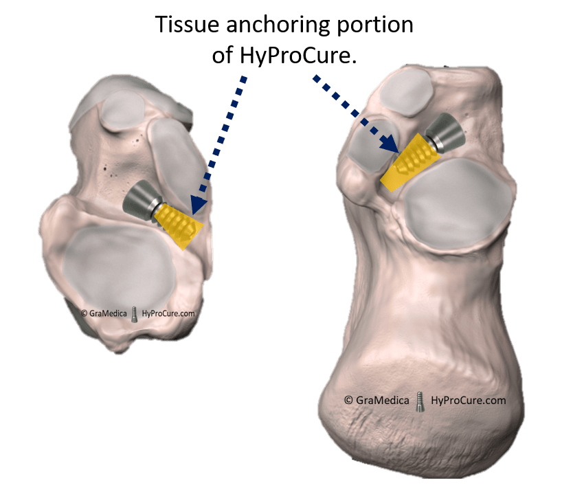 HyProCure anchored into the most stable soft tissues deep within the sinus tarsi space